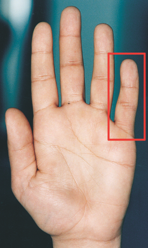 כיסים אוטיסטים